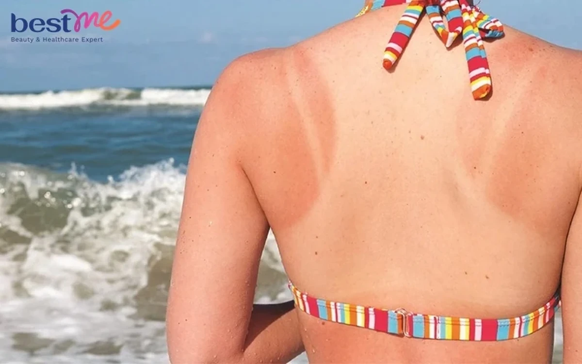 cháy nắng là điều thường gặp và gây ra điều khó chịu không nhỏ
